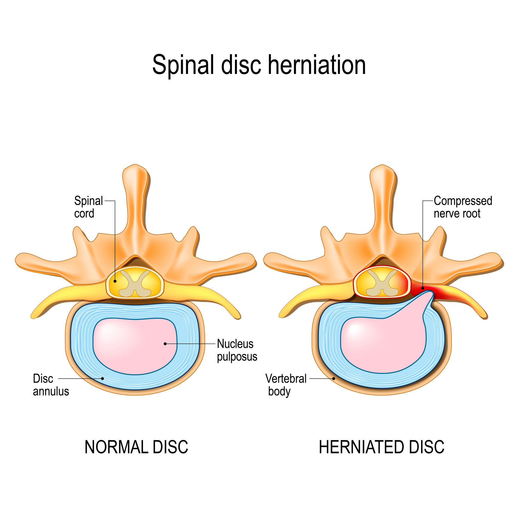 ISSA, International Sports Sciences Association, Certified Personal Trainer, ISSAonline, Personal Trainer's Guide: Exercising After a Herniated Disc